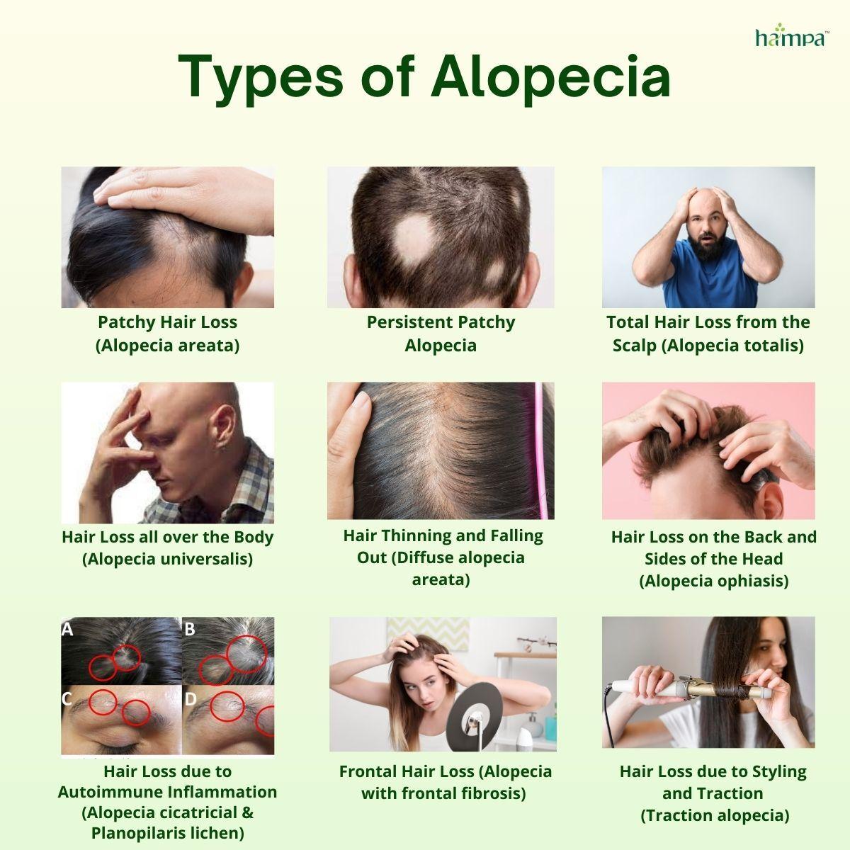 Types of Alopecia